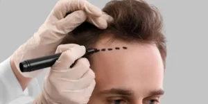 Does Insurance Cover Any Aspect of Hair Transplant Cost UK?