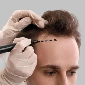 Does Insurance Cover Any Aspect of Hair Transplant Cost UK?