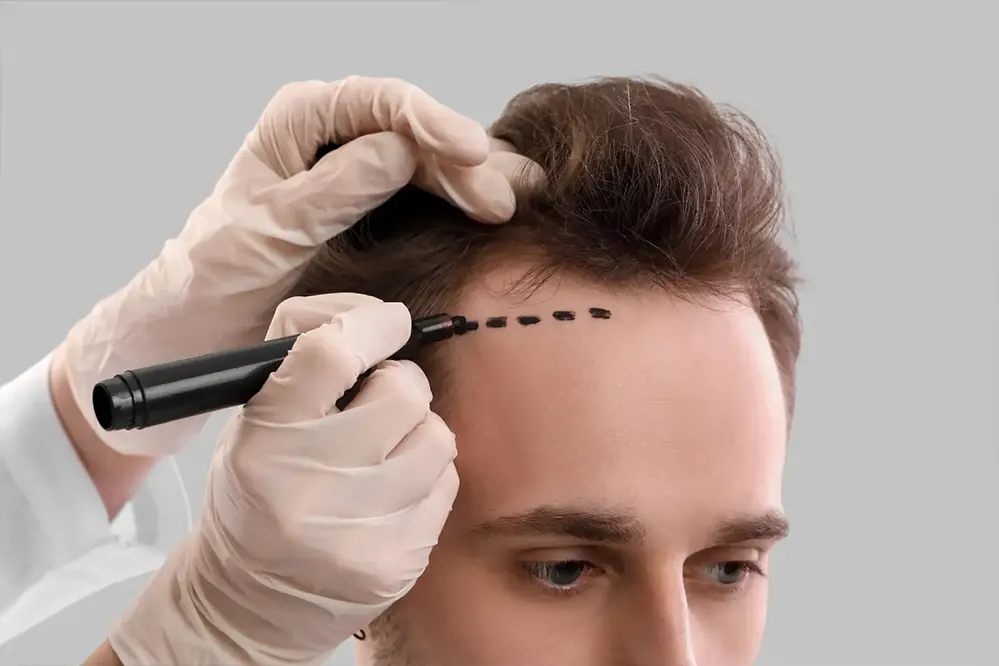 Does Insurance Cover Any Aspect of Hair Transplant Cost UK?